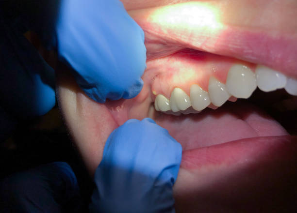 Best Emergency Care for Gum Disease in Valley Cottage, NY
