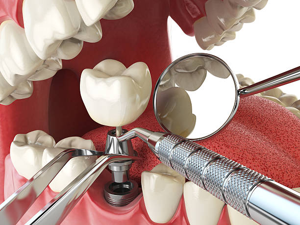 Best Dental Abscess Treatment in Valley Cottage, NY