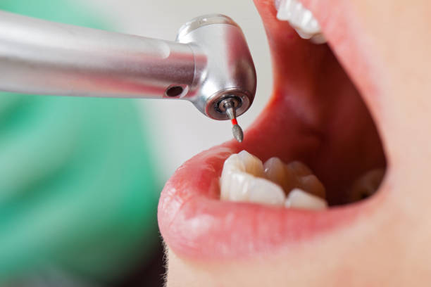 Best Knocked-Out Tooth (Avulsed Tooth) Treatment in Valley Cottage, NY